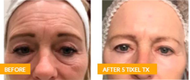 Antes y Después de 5 Sesiones de Tixel®