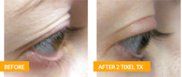 Antes y Después de 2 Sesiones de Tixel®