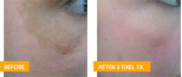 Antes y Después de 3 Sesiones de Tixel®
